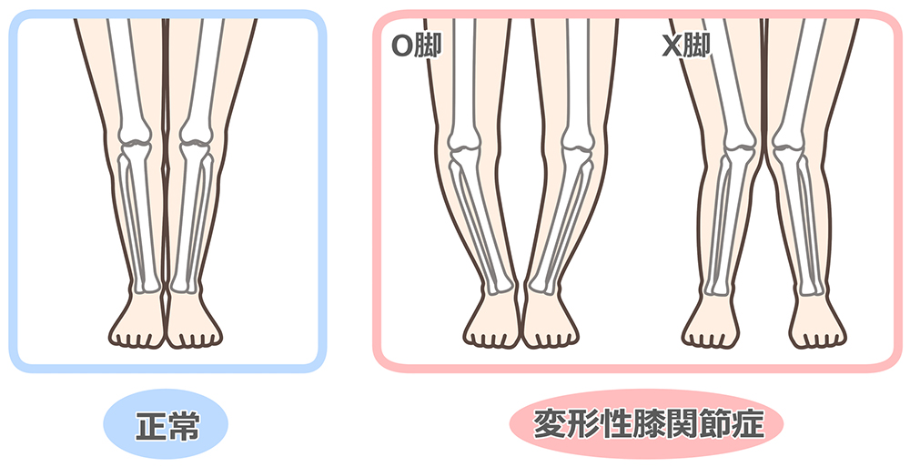 変形性膝関節症とは