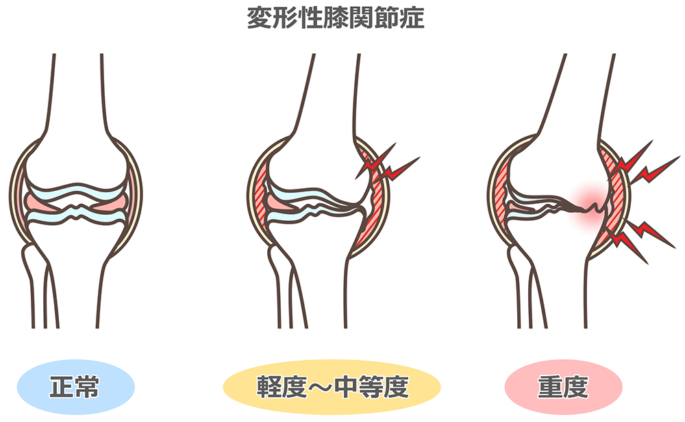 変形性膝関節症の症状