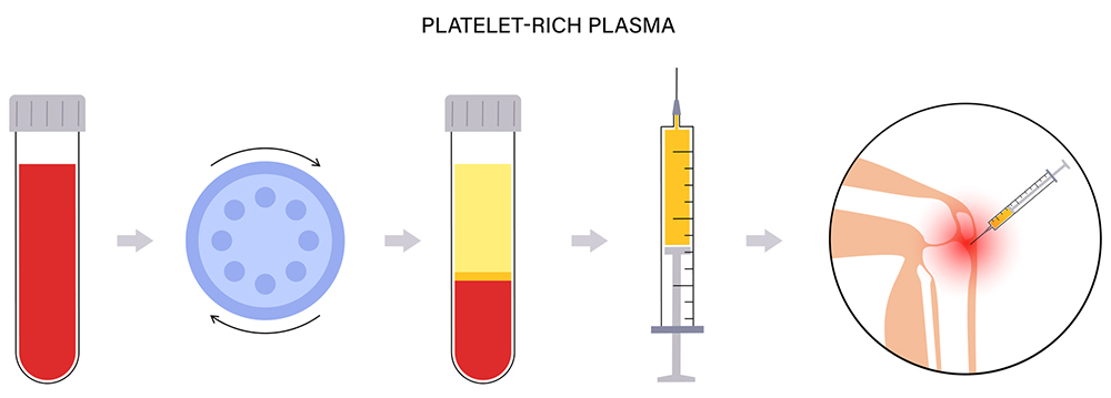 PRP療法とは